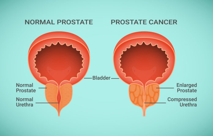 cancer prostate bph benignprostatic hyperplasia