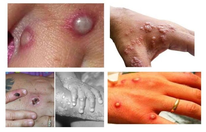 Monkeypox Emmanuel microb Twitter 05202022