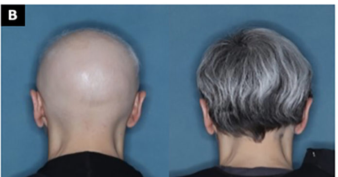 13alopecia promo facebookJumbo