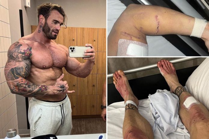 calum von moger injuries