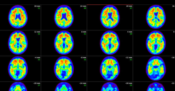 17Alzheimers phlc facebookJumbo